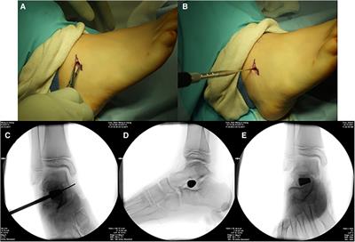 Mid-term assessment of subtalar arthroereisis with Talar-Fit implant in pediatric patients with flexible flatfoot and comparing the difference between different sizes and exploring the position of the inserted implant